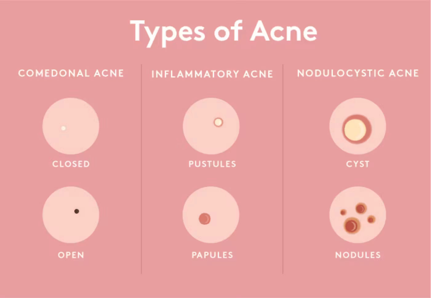 Types Of Acne
