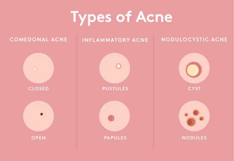 Types Of Acne